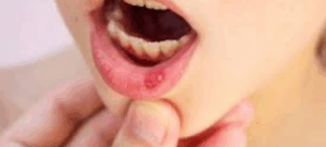 Alerta por brote de Enfermedad Boca-Mano-Pie en Nariño